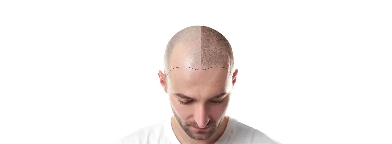 Cuoio capelluto con diradamento dei capelli, l'inestetismo su cui interviene la tricopigmentazione